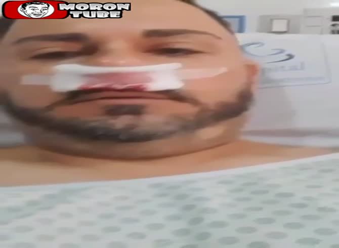 Video :How he shattered his nose will surprise you!